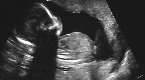 Unborn Baby Ultrasound