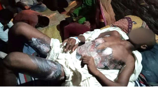 When This 16-Year-Old Indian Pastor Refused to Back Down, He Was Severely Burned With Acid